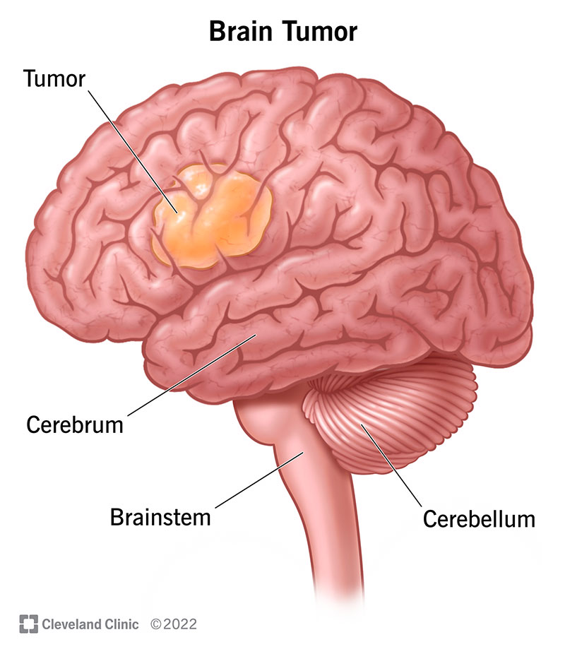 More than 24000 deaths occurs every year due to Brain Tumour in India